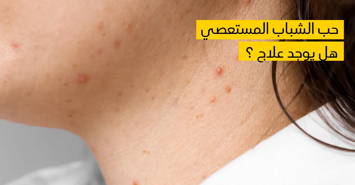 حب الشباب المستعصي هل يوجد علاج ؟